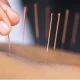 طب سوزنی